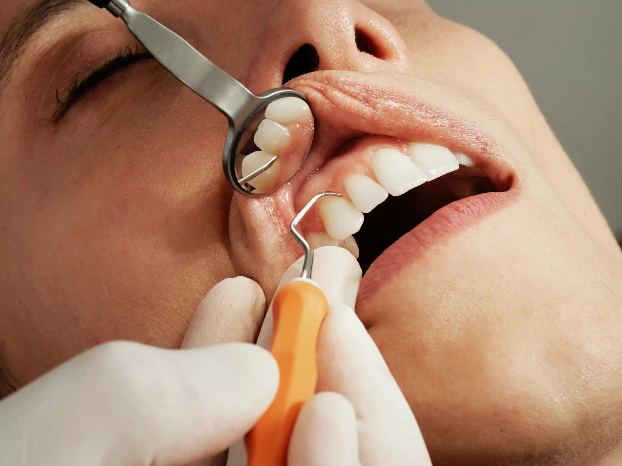 Dental Teeth Scaling