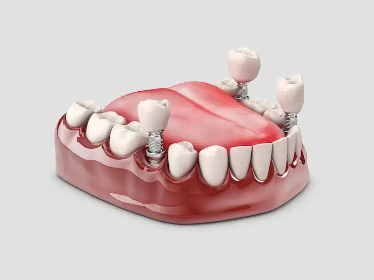 Single Dental Implant