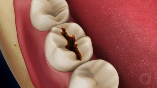 amalgam or silver dental fillings