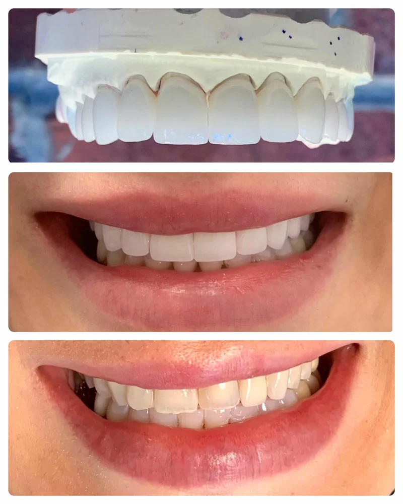 thumbnail image 2 of Dental Resin Composite Veneers For Front Teeth – Upper/Lower, Crowns Whitening Kit 2 of 3