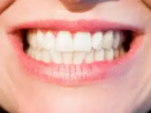Laser-Teeth-Whitening