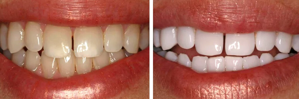 Teeth Whitening Before and After