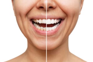 Dental Veneers Before and After