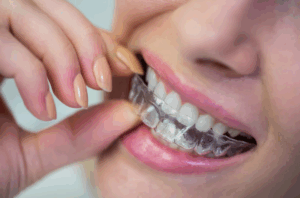 Invisalign Dentist