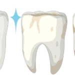 Broken Tooth Repair Dentist