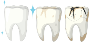 Broken Tooth Repair Dentist