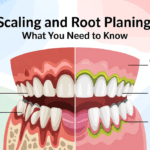 Scaling and Root Planing